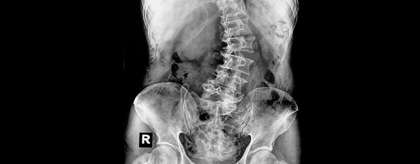 Patient suffering from Scoliosis in need of chiropractor in Hendersonville